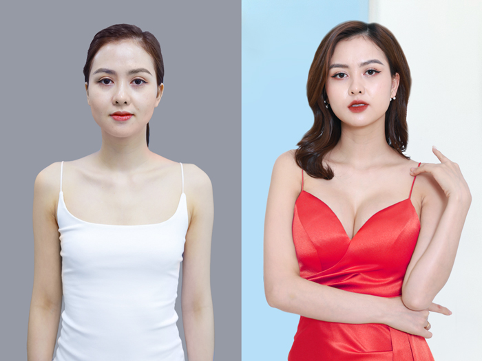 Huyền Giang gặp tình trạng vòng 1 teo lép, thiếu đầy đặn. Sau nâng ngực vòng 1 tròn đầy và cân đối hơn với cơ thể