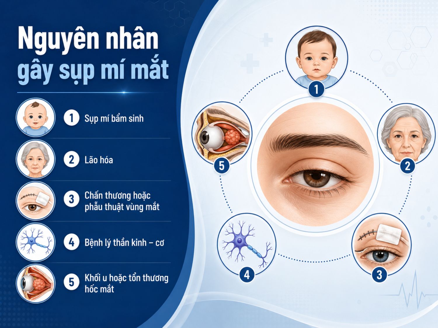 Sụp mí mắt có thể xuất phát từ yếu tố bẩm sinh, quá trình lão hóa, chấn thương hoặc phẫu thuật vùng mắt, bệnh lý thần kinh – cơ và khối u trong hốc mắt.