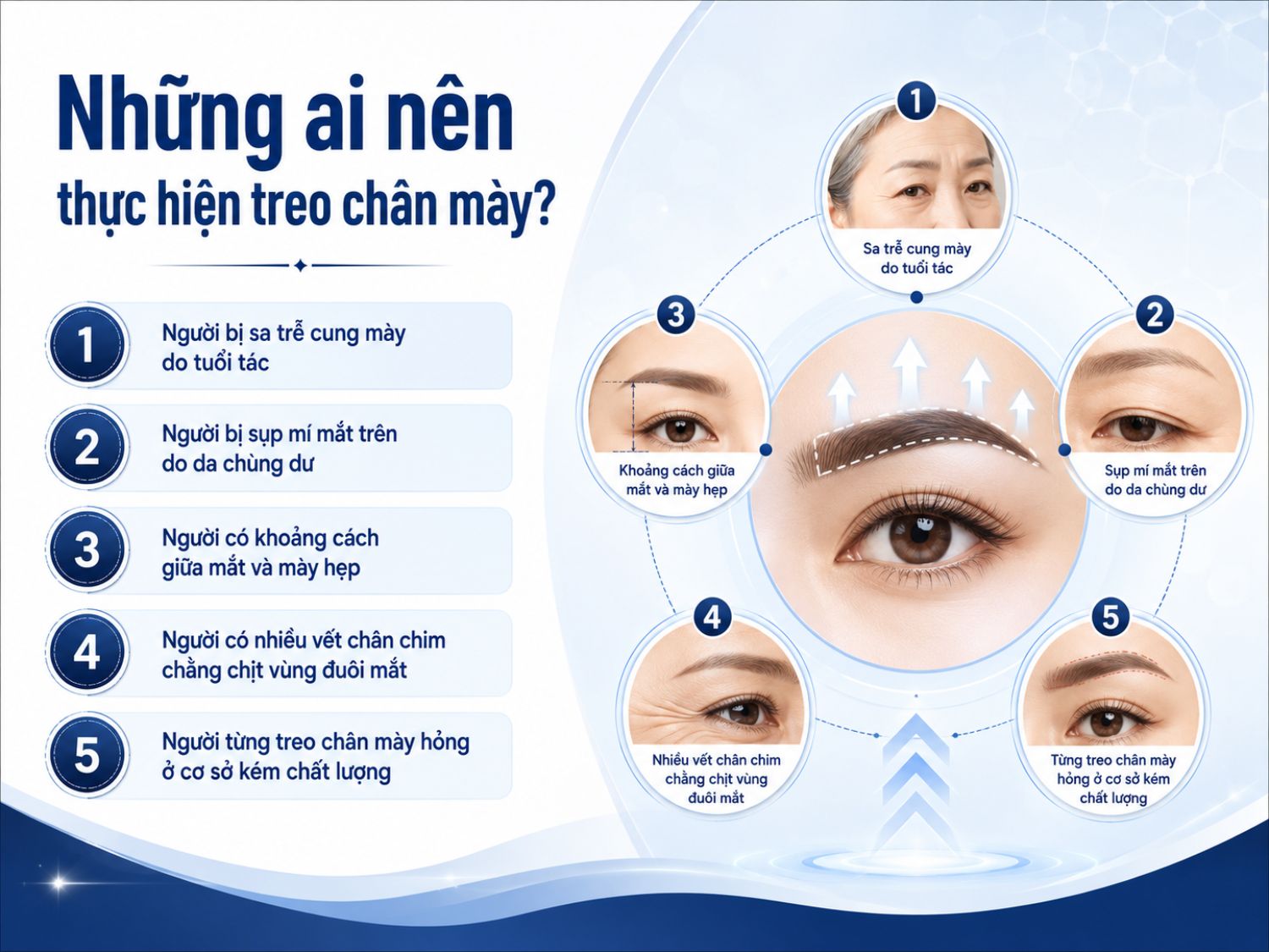 Treo chân mày thường phù hợp với người có cung mày sa trễ theo tuổi tác, mí trên chùng da, khoảng cách mắt – mày hẹp, nhiều vết chân chim vùng đuôi mắt hoặc cần khắc phục kết quả treo chân mày hỏng trước đó.