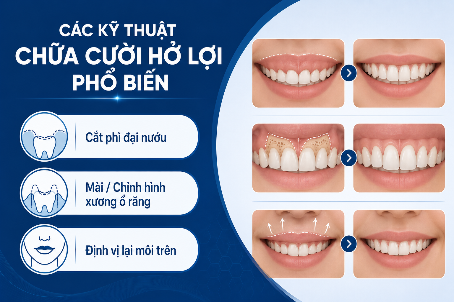 ảnh mô tả Các kỹ thuật chữa cười hở lợi phổ biến