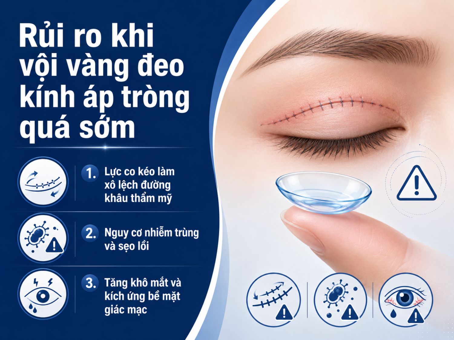 Đeo kính áp tròng quá sớm sau cắt mí có thể làm ảnh hưởng đến quá trình hồi phục, tăng nguy cơ xô lệch đường khâu, kích ứng mắt và nhiễm trùng. Người vừa phẫu thuật mí nên tuân thủ đúng thời điểm sử dụng kính áp tròng theo hướng dẫn của bác sĩ.