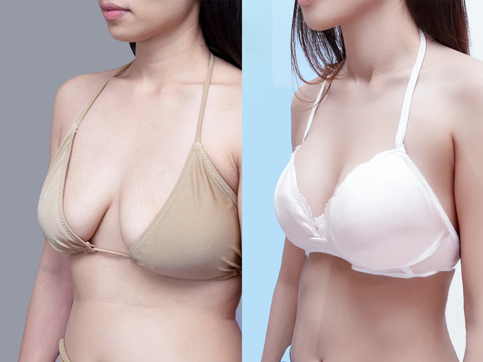 Treo ngực sa trễ kết hợp Đặt túi ngực giải quyết tình trạng xệ, vừa khôi phục thể tích giúp vòng 1 căng tròn