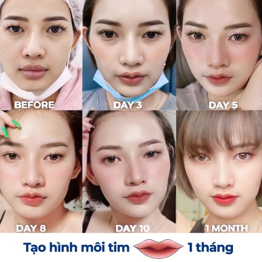 quá trình khách phục hồi sau khi tạo hình môi