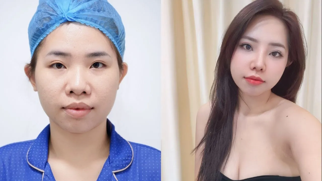 khách Thanh Hằng nâng mũi dáng S line tự nhiên tại Kangnam, ảnh trước và sau phẫu thuật