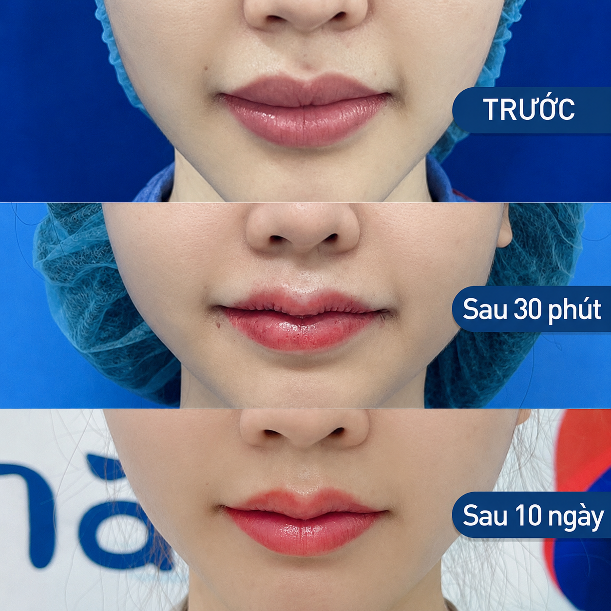 khách hàng cắt môi tim tại Kangnam hồi phục nhanh , lành đẹp và kết quả tự nhiên