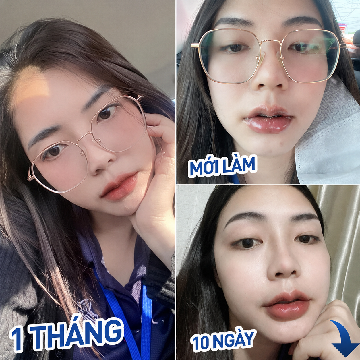 quá trình phục hồi của khách hàng cắt môi trái tim tại Kangnam