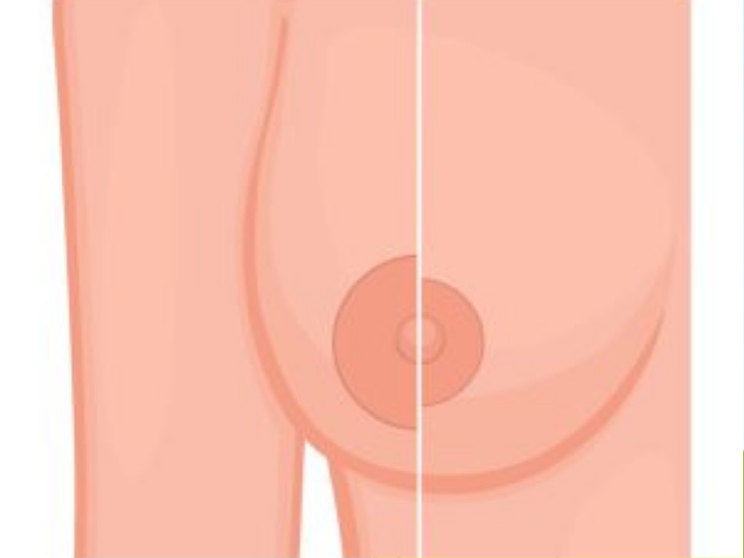 Thu gọn quầng ngực sau sinh không ảnh hưởng tuyến sữa, ảnh mô phỏng trước - sau