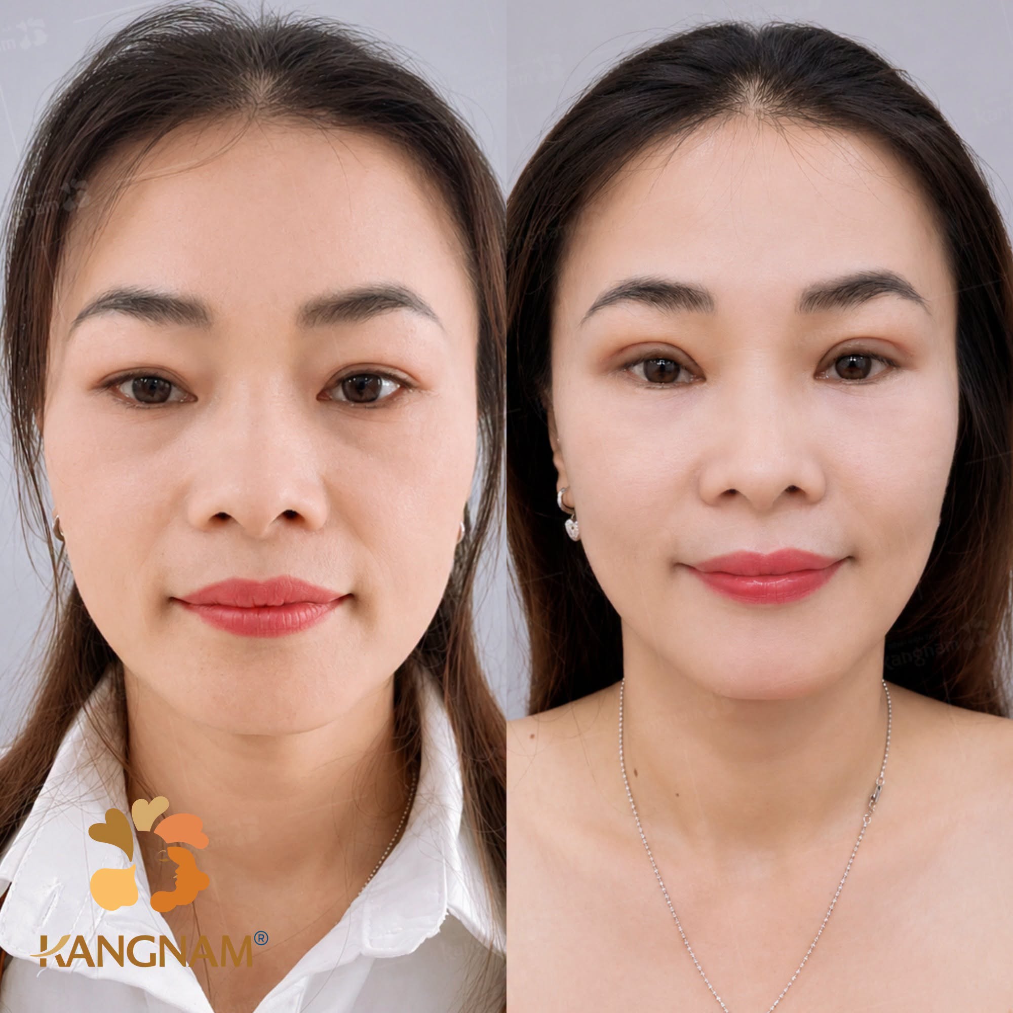 Khách hàng được trẻ hóa vùng mắt sau khi cắt mí tại Kangnam