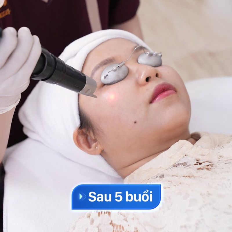 khách hàng được bắn tia laser điều trị da sau 5 buổi da đã cải thiện rõ