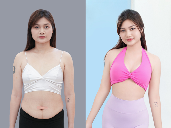 Vùng hông, eo của khách hàng được loại bỏ mỡ thừa nhanh chóng