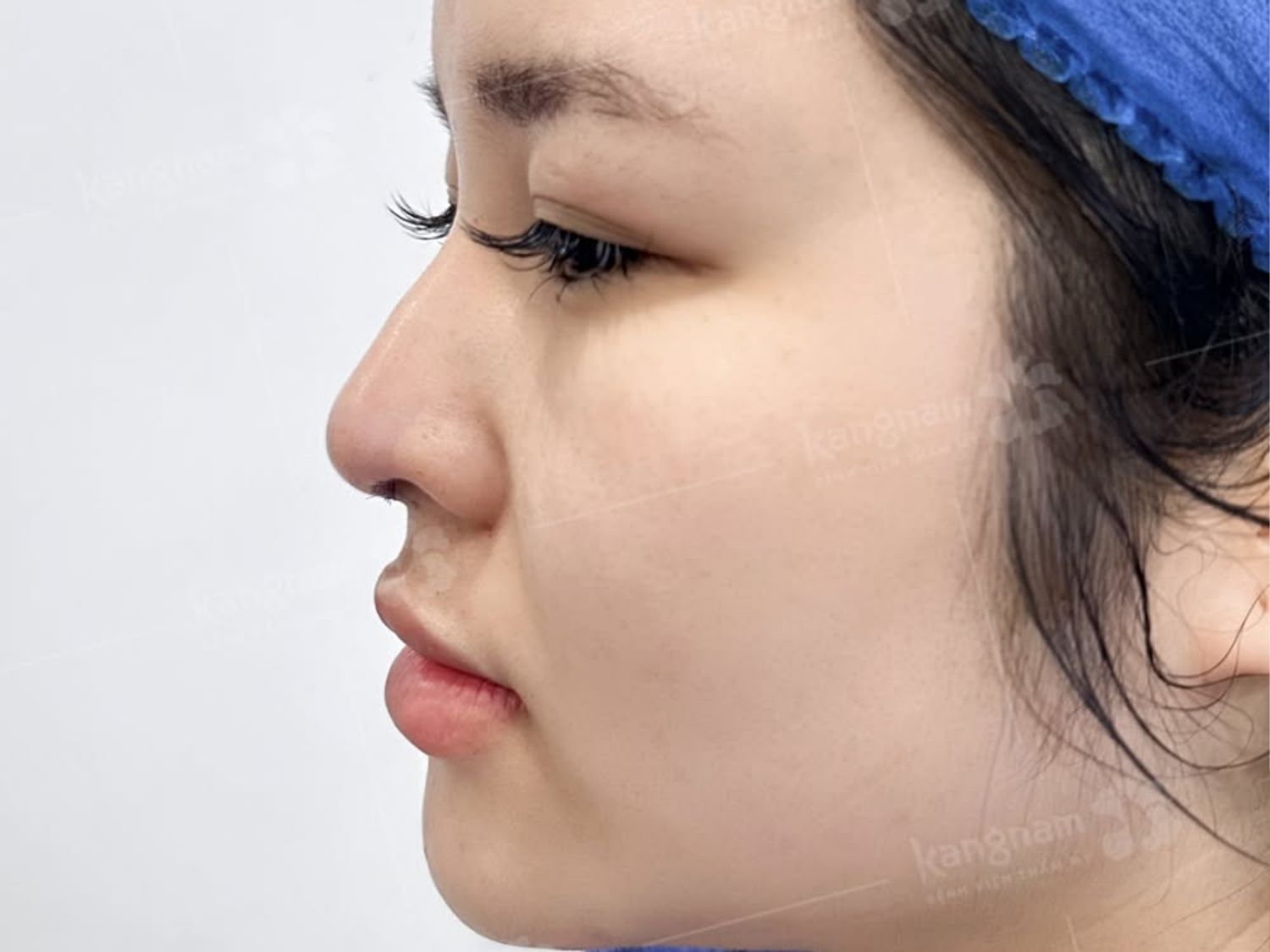 khách hàng mũi gồ nhẹ ở sống mũi khiến gương mặt thiếu nữ tính