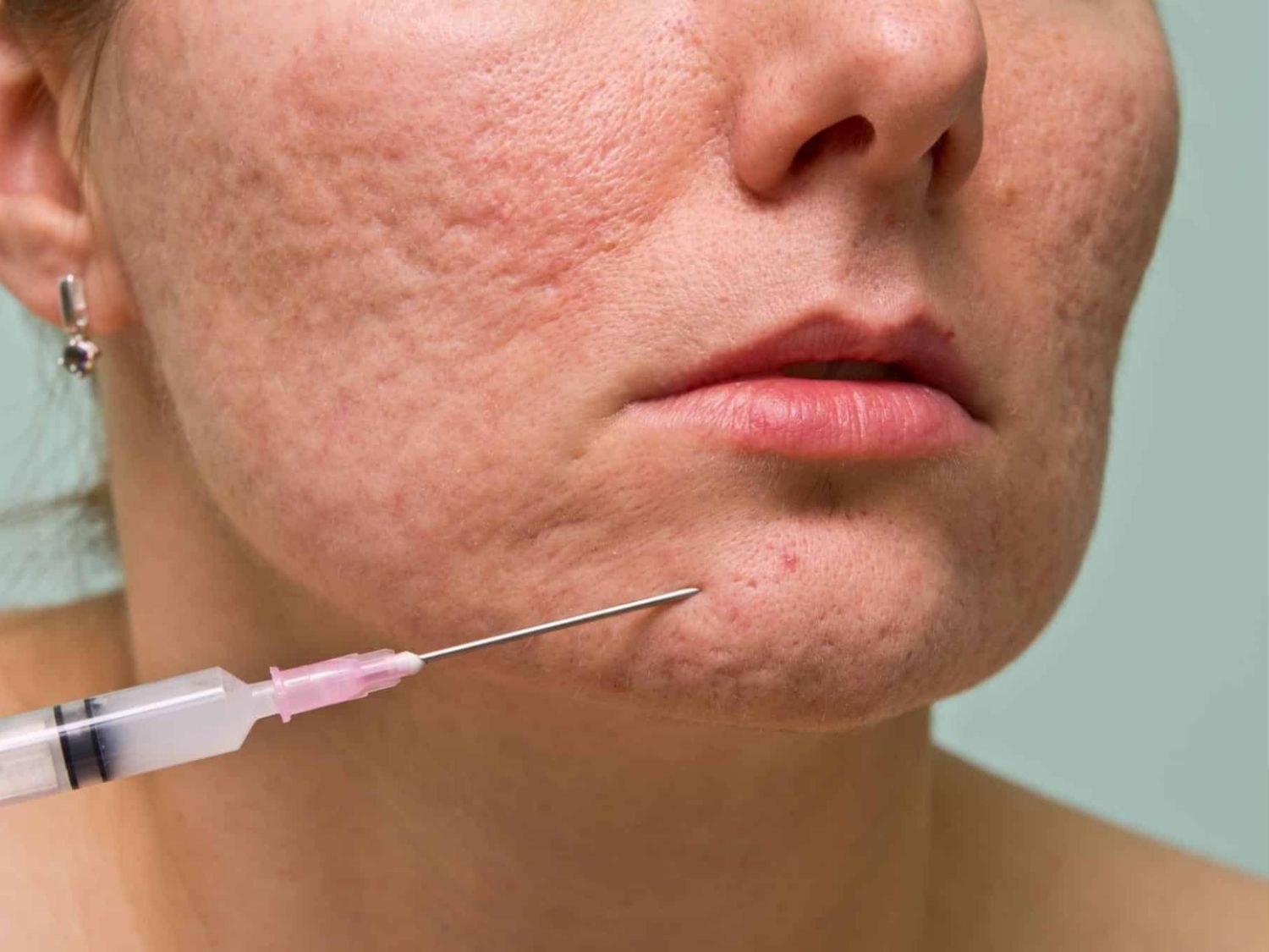 bóc tách sẹo rỗ dùng kim chuyên dụng xuyên qua da