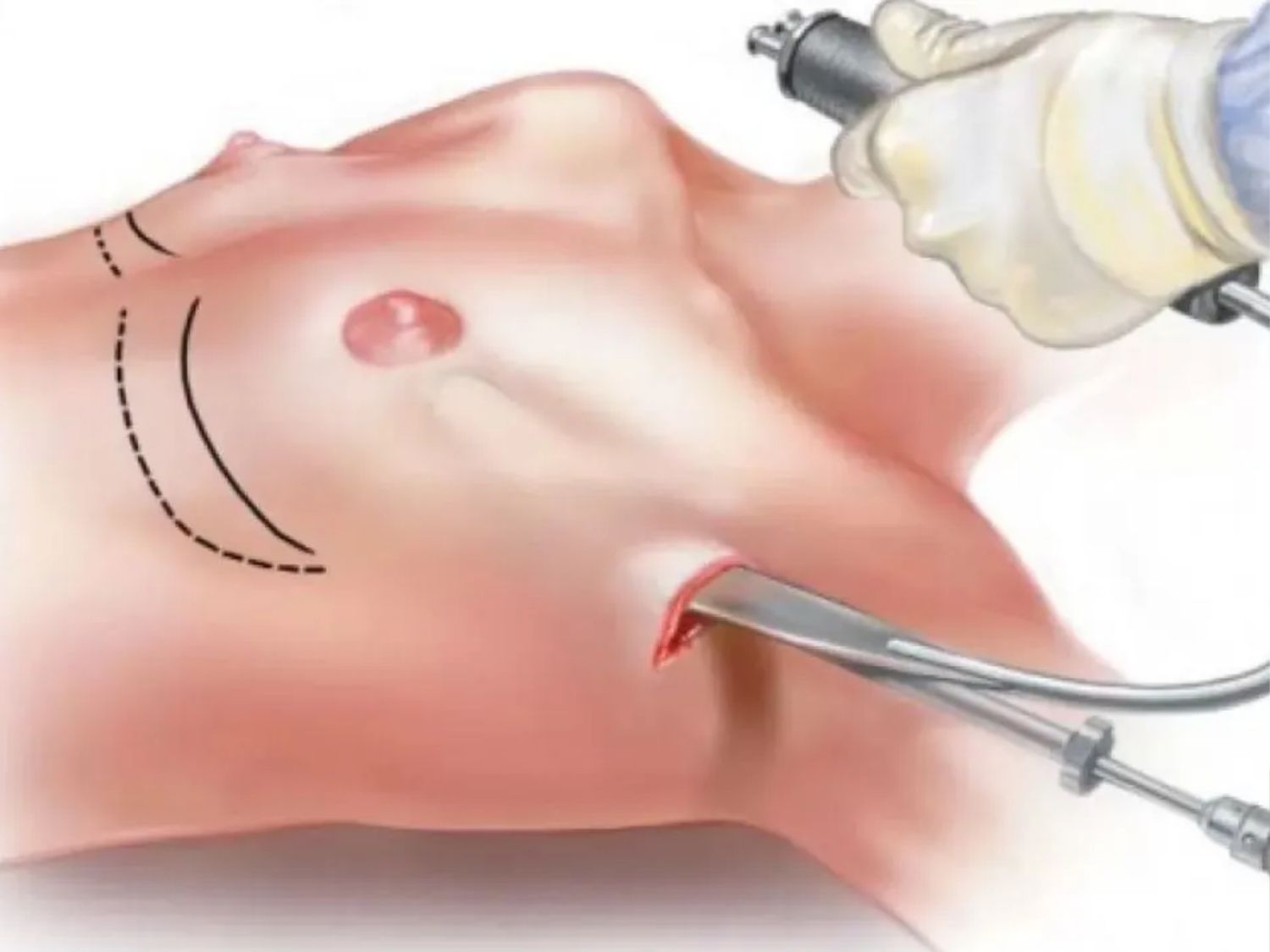 Nâng ngực đường nách là đưa túi ngực vào khoang thông qua đường mổ nhỏ nằm trong nếp gấp vùng nách