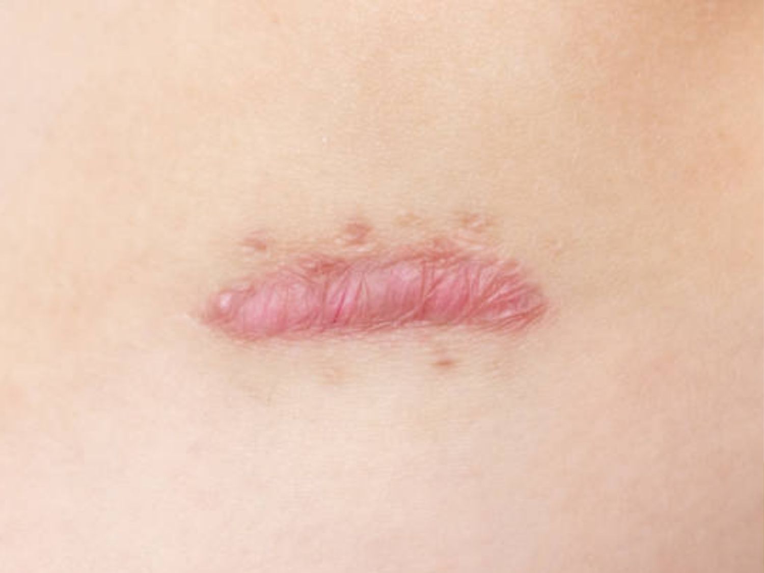 Sẹo lồi lâu năm do collagen tăng sinh quá mức đã tạo thành mô xơ dày, chắc và có thể tiếp tục phát triển ngoài ranh giới vết thương ban đầu