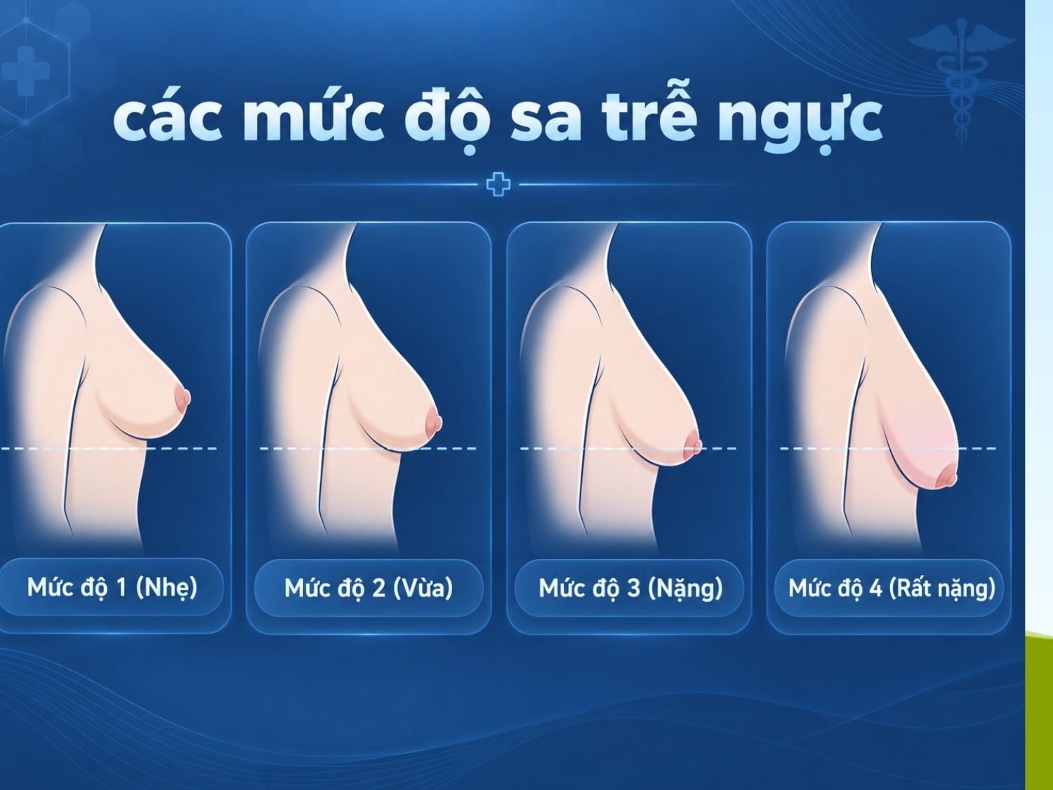 4 mức độ sa trễ ngực và hình ảnh mô tả
