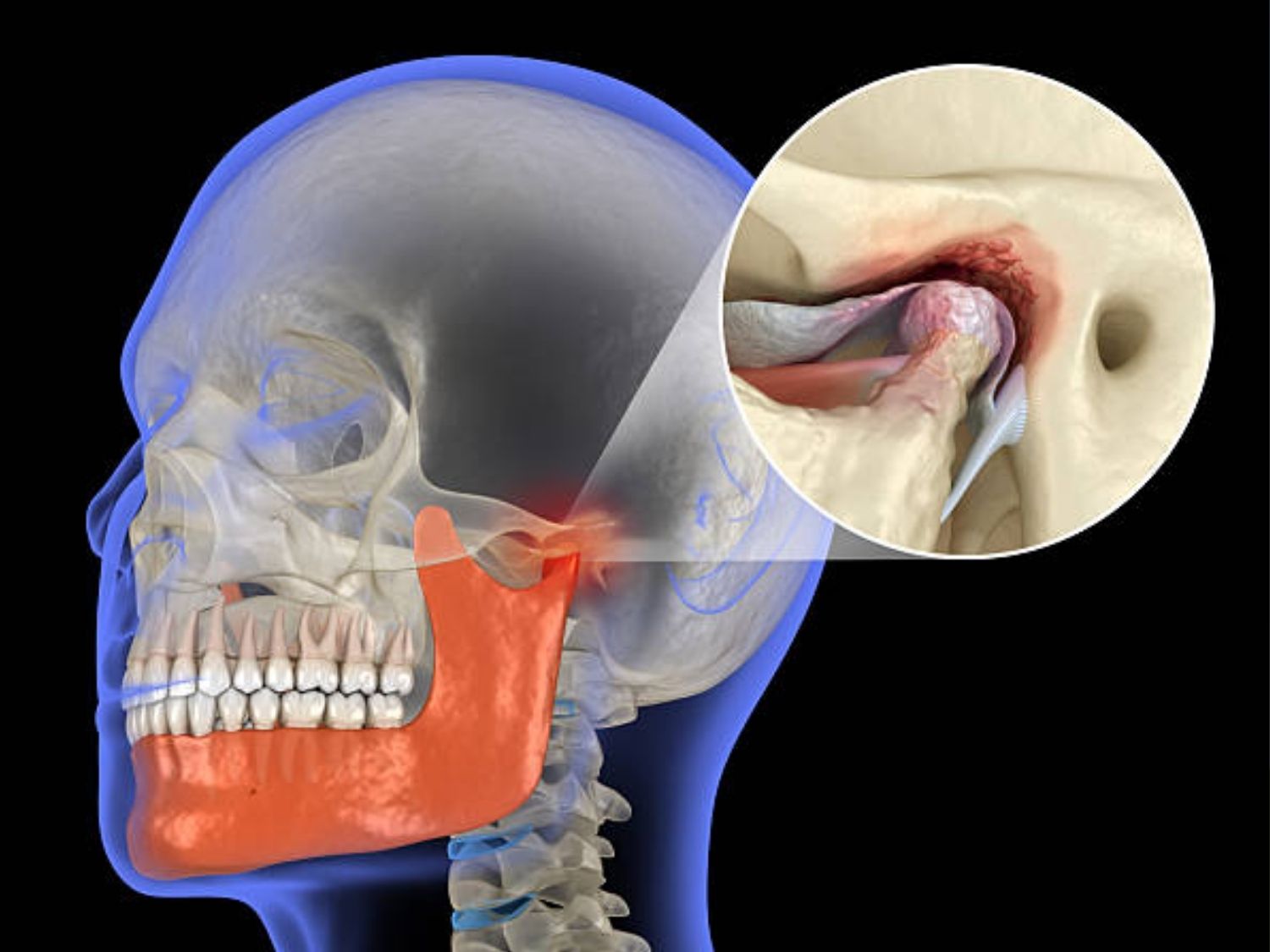 Di chứng sau gãy nhiều xương vùng mặt cần cân nhắc phẫu thuật điều chỉnh