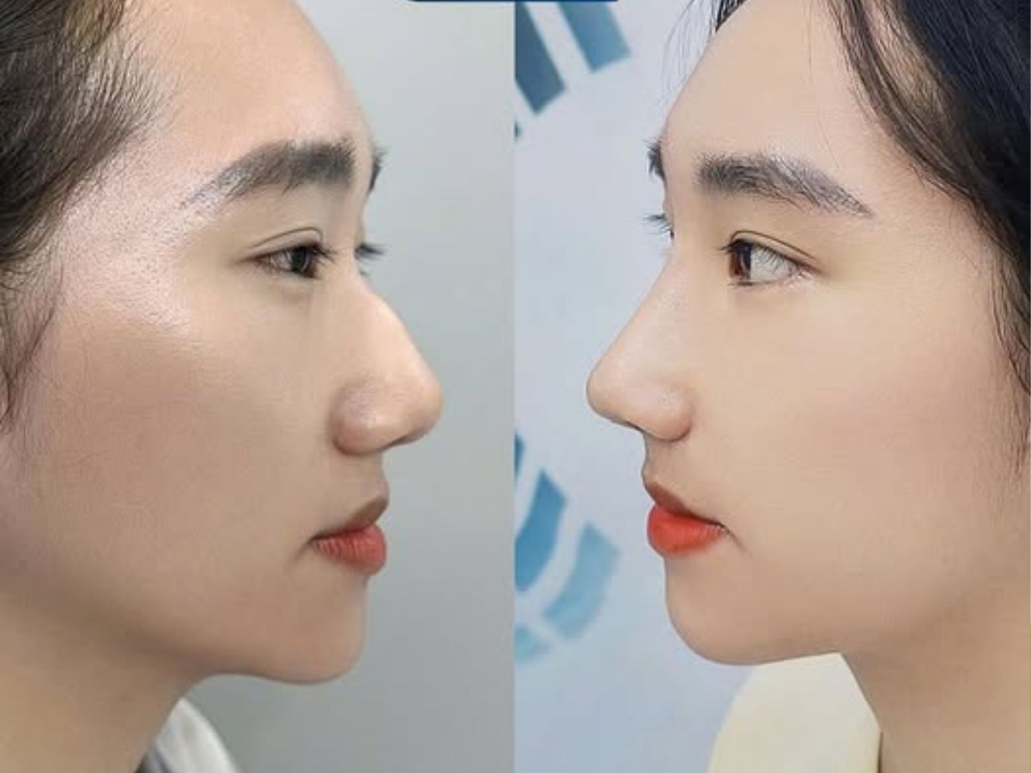 Khách trước và sau khi sửa mũi gồ tại Kangnam, gương mặt nữ tính hơn