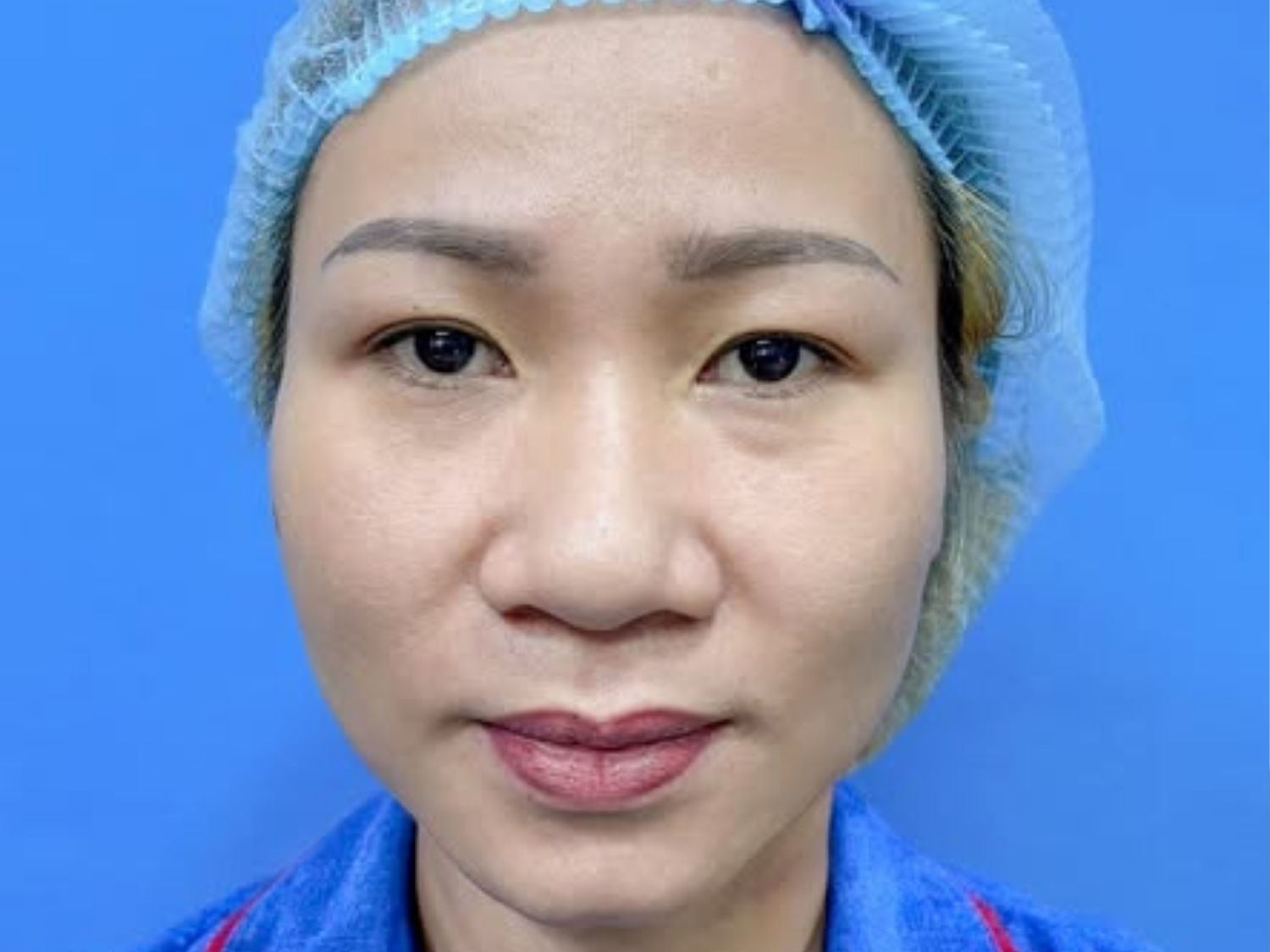Trường hợp đầu mũi to do mô mềm của khách hàng