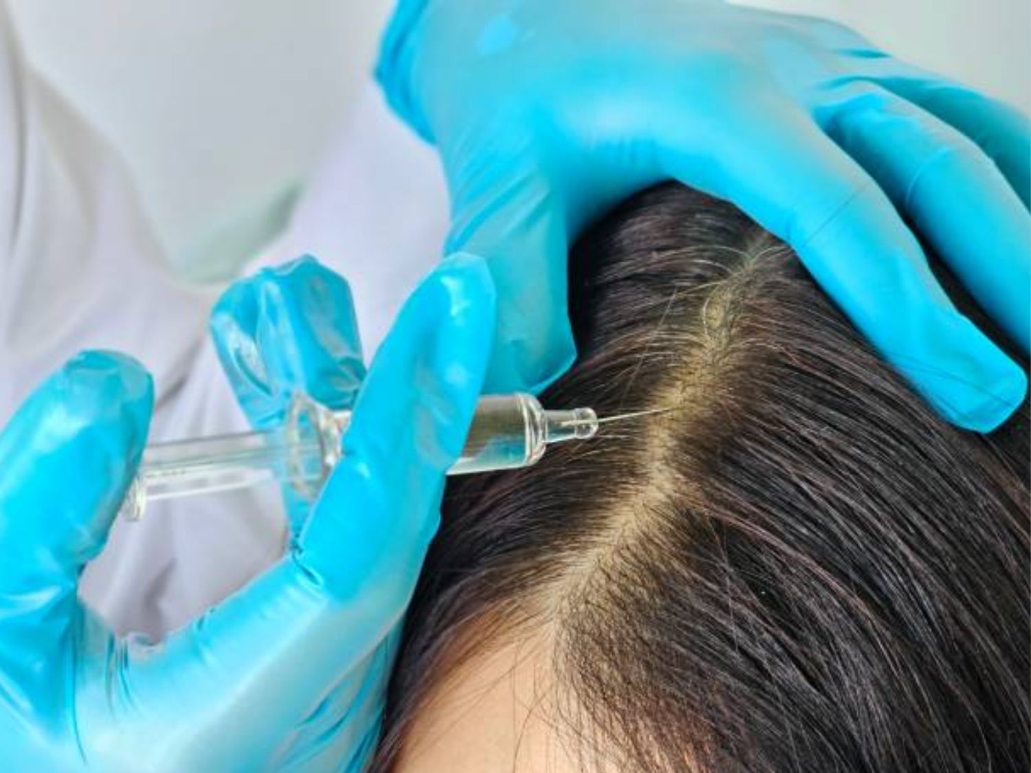 Tiêm Meso Hair đưa dưỡng chất vào các nang tóc, cải thiện tình trạng rụng tóc, hói