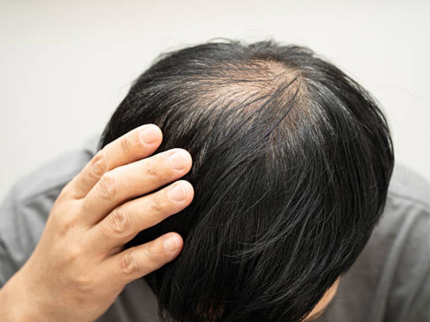 Rụng tóc lâu năm vẫn có khả năng cải thiện nhưng còn tùy vào nang tóc
