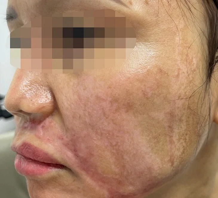 Sử dụng thuốc hoặc kem trị nám không phù hợp có thể khiến da kích ứng, suy yếu hàng rào bảo vệ và xuất hiện các vùng tăng sắc tố đậm màu.