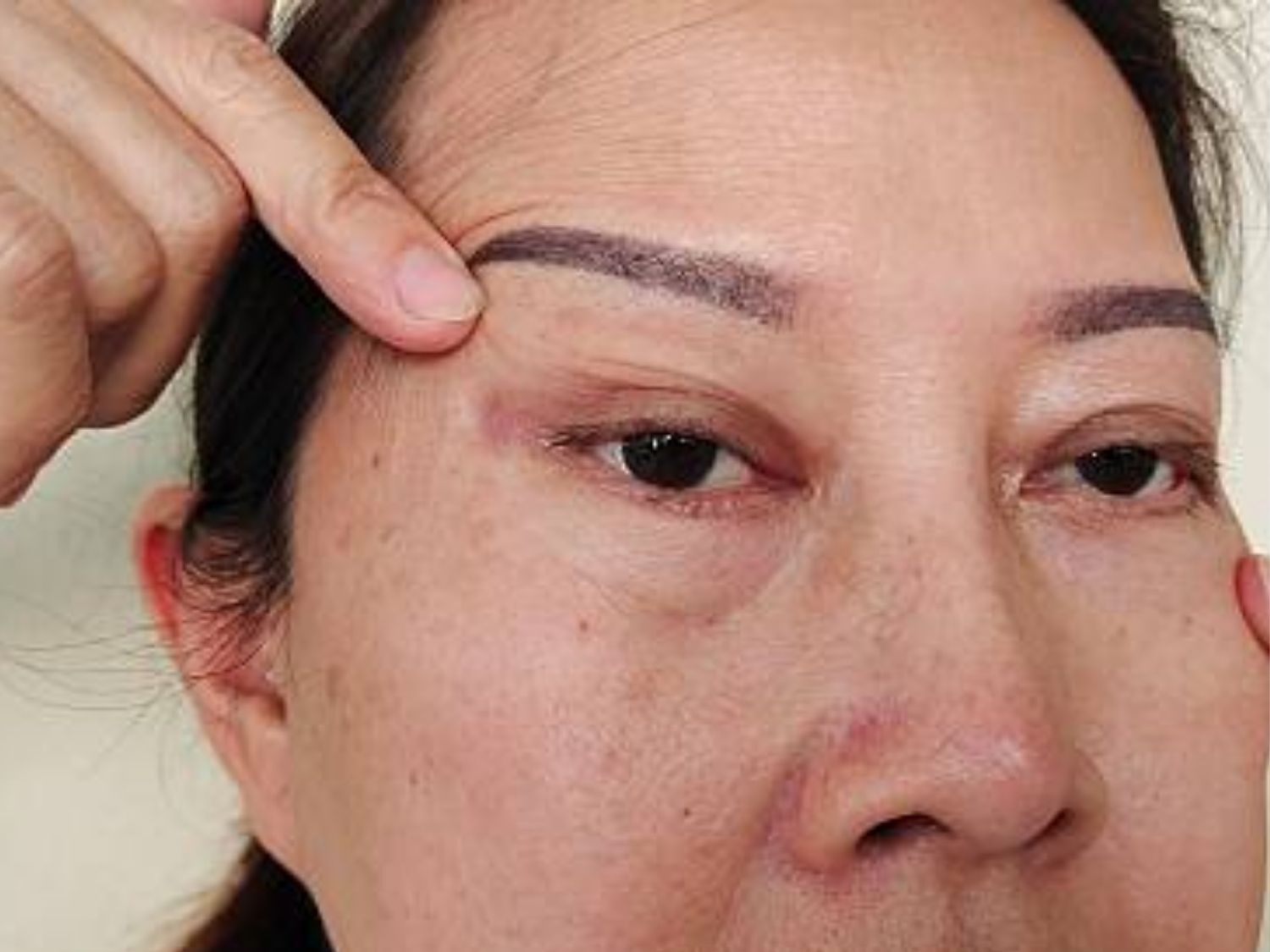 Không tự ý massage vùng mắt khi bị sụp mí sau tiêm botox