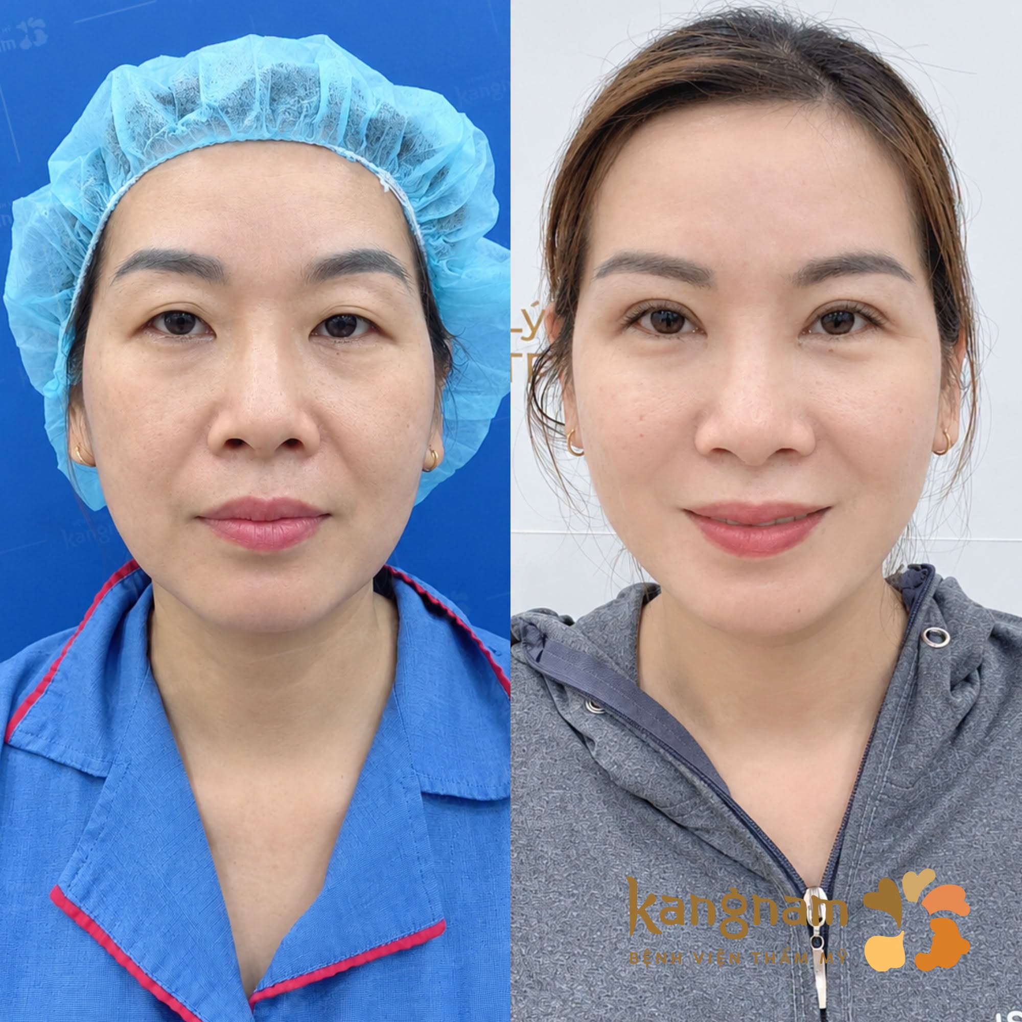 So sánh trước – sau cho thấy nếp mí rõ hơn, vùng da chùng được cải thiện và tổng thể đôi mắt trông gọn, cân đối hơn.