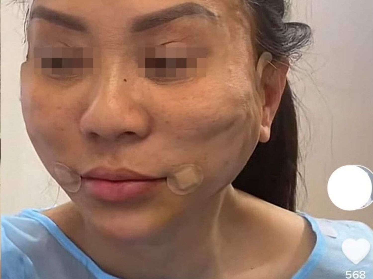 mặt lõm gồ ghề sau khi căng chỉ cần thăm khám với bác sĩ