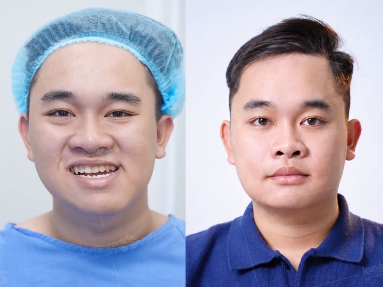 ảnh trước và sau của khách chỉnh xương hàm lệch. Sau phẫu thuật sở hữu gương mặt cân đối