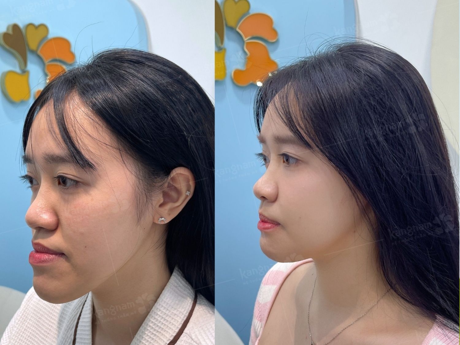 khách móm do xương hàm dưới quá phát. Sau phẫu thuật gương mặt cân đối, hài hòa