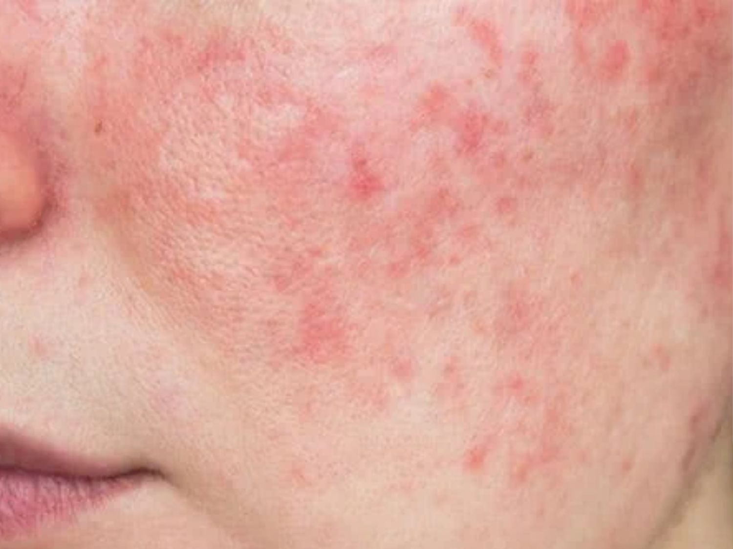 Da nhiễm corticoid phục hồi được ở phần lớn trường hợp nhận biết sớm và có phác đồ phù hợp