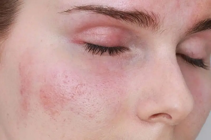 Sau laser trị nám khách hàng có thể gặp tình trạng nóng, rát đỏ da