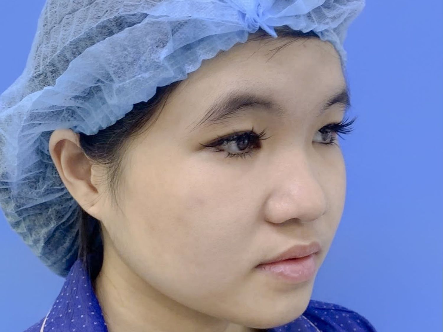 Lớp da, mô mỡ và mô liên kết vùng đầu mũi dày hơn bình thường khiến đầu mũi to