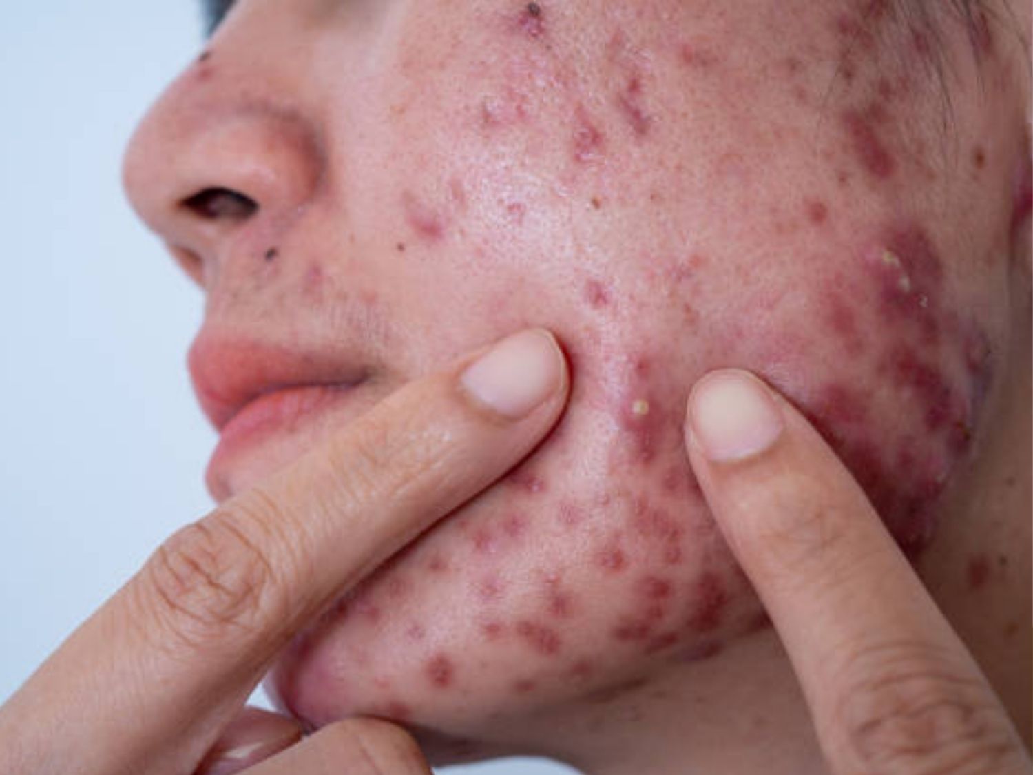 Các nốt mụn lớn, sưng đau hoặc có nguy cơ để lại thâm sẹo lên rộng trên da