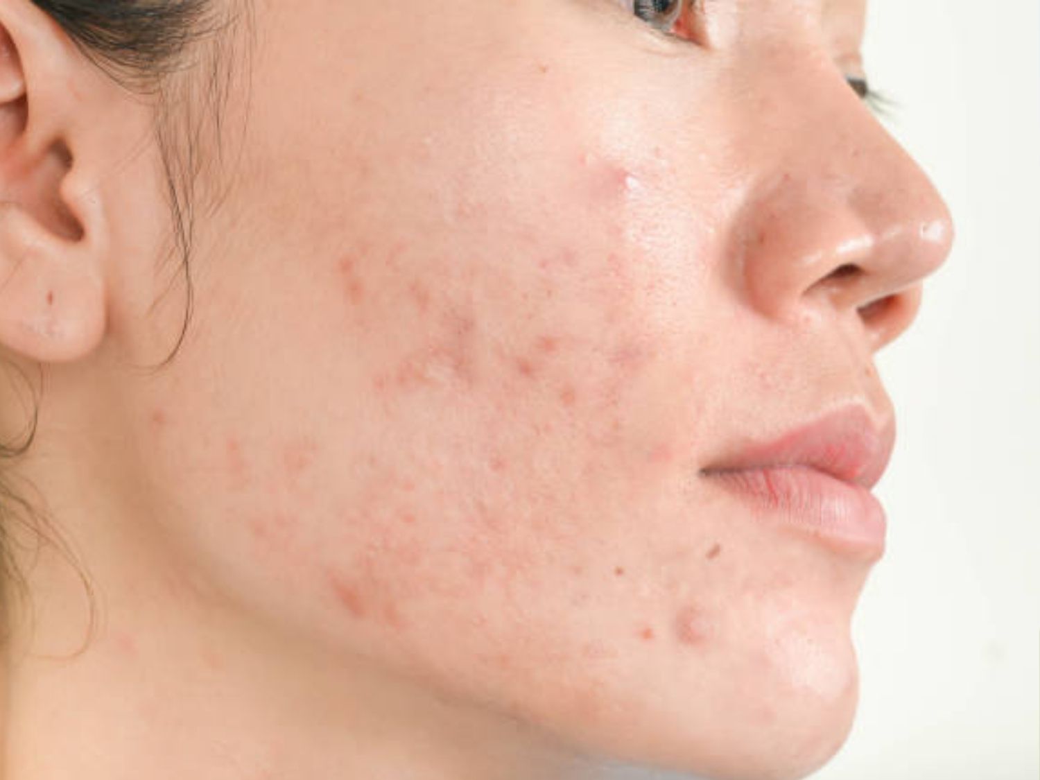 Mụn để lại nhiều thâm ở má mà góc hàm
