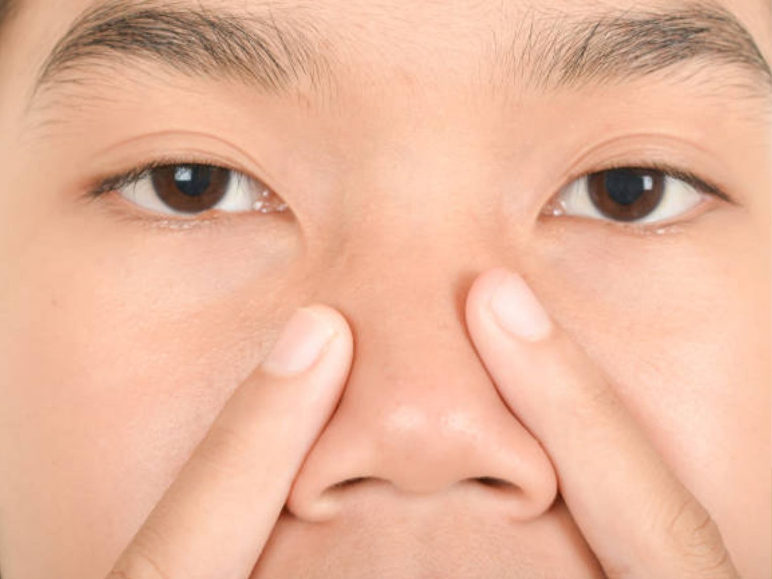Mũi vẹo có thể do bẩm sinh hoặc do lỗi phẫu thuật thẩm mỹ