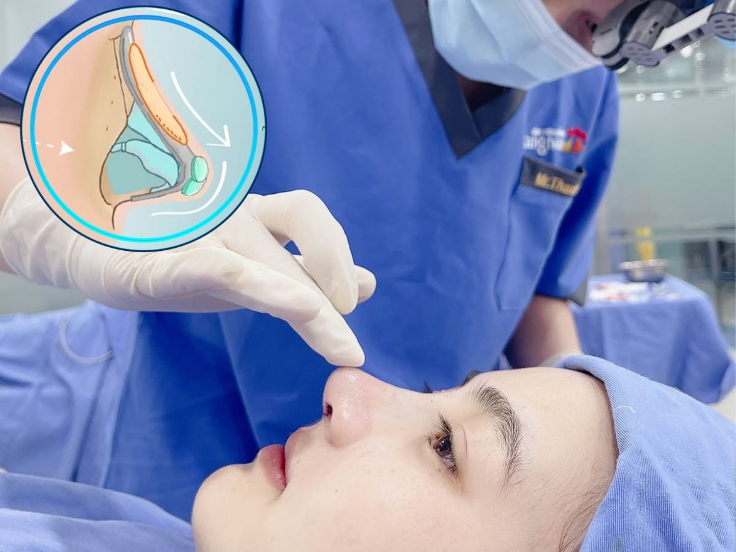 Khách hàng nâng mũi cấu trúc, dáng mũi được thiết kế hài hòa