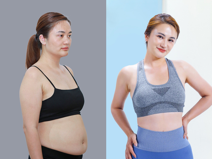 Kết quả giảm mỡ Lipo trước – sau cho thấy vùng bụng và eo gọn hơn sau quá trình giảm mỡ, đồng thời đường nét cơ thể cân đối hơn.