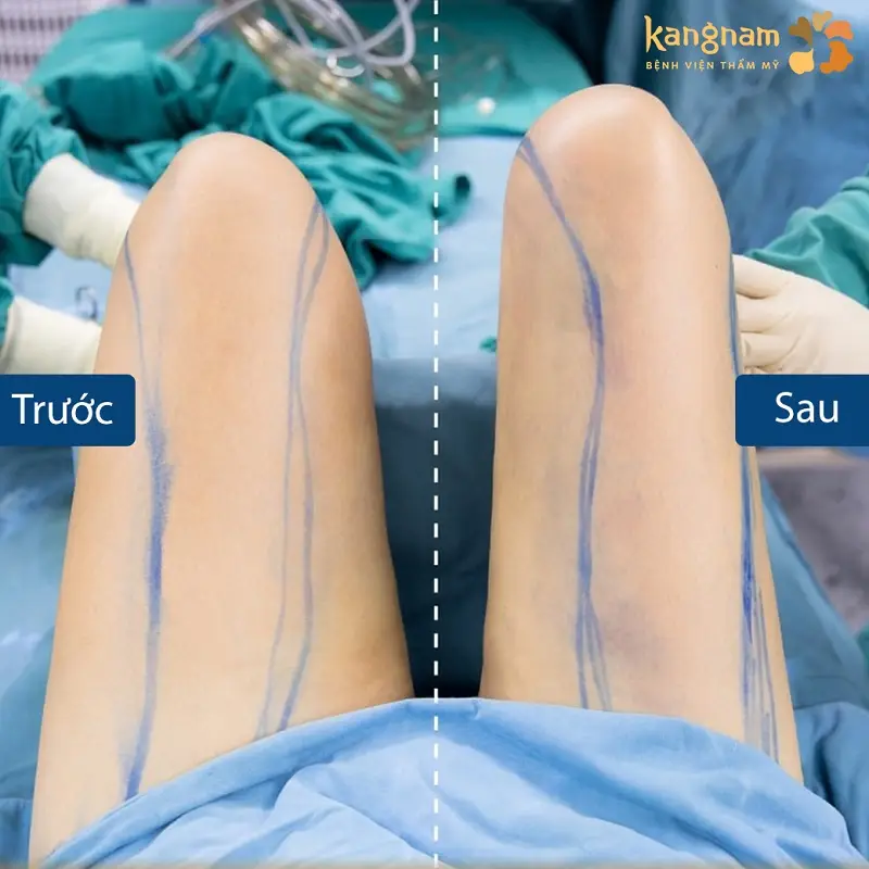 Kết quả giảm mỡ đùi rõ rệt sau khi vừa hút mỡ