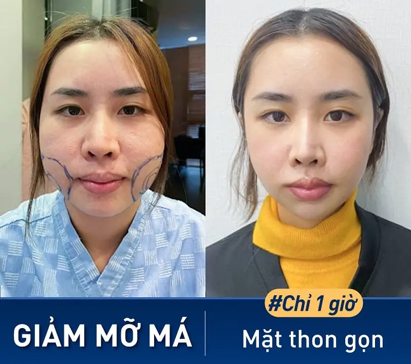 Vùng má được loại bỏ mỡ thừa nhanh chóng, giúp gương mặt thon gọn