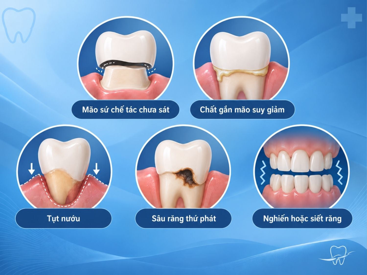 Nguyên nhân hở cổ răng sứ sau khi phục hình gồm mão sứ chưa sát, keo hết công dụng