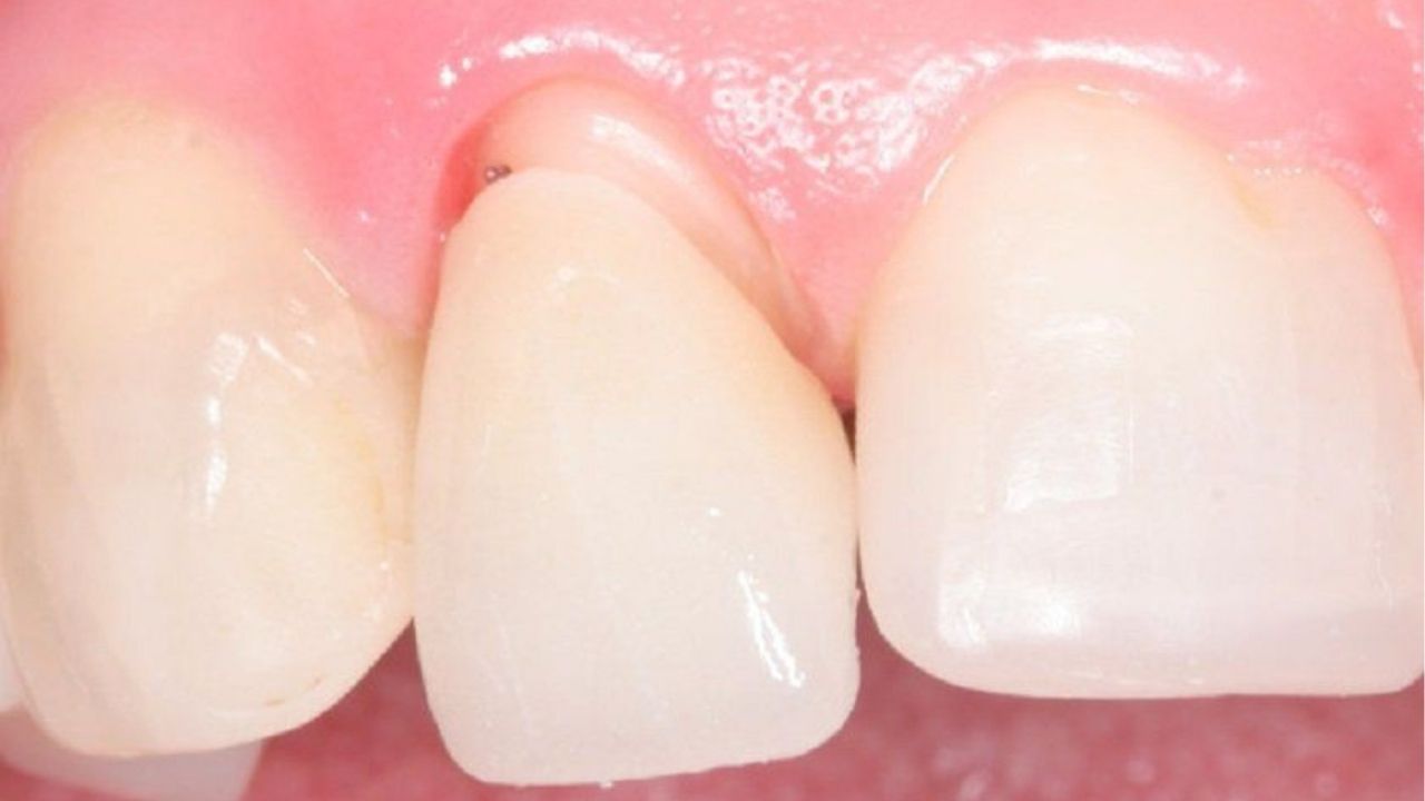 Hở cổ răng sứ: Nguyên nhân, dấu hiệu và cách khắc phục hiệu quả