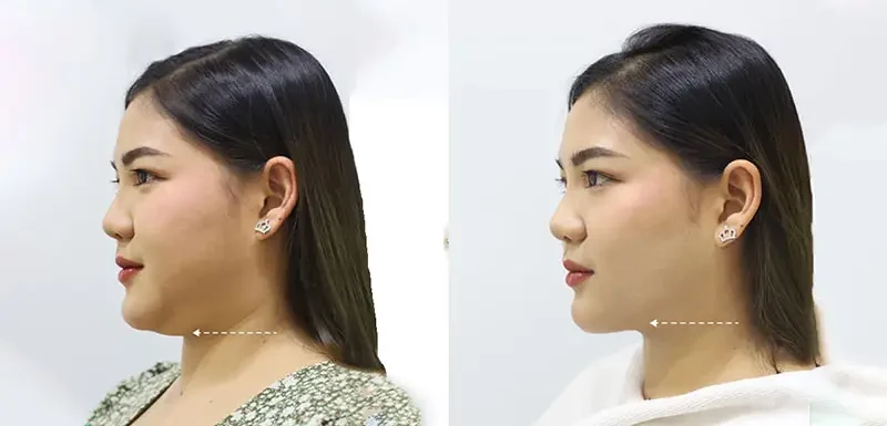 Sử dụng ống nhỏ để loại bỏ mỡ thừa ra ngoài