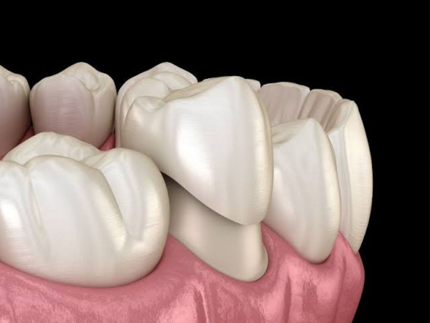Trường hợp lỏng vít hoặc mão sứ