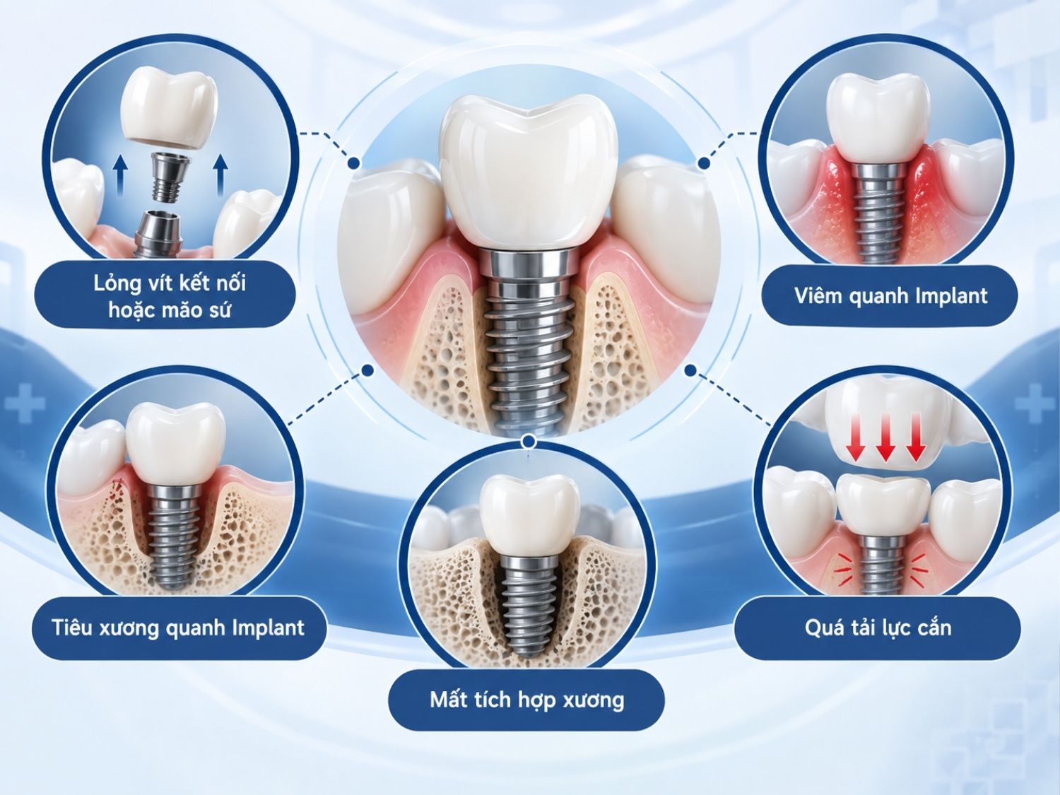 Nguyên nhân và cách nhận biết Implant bị lung lay