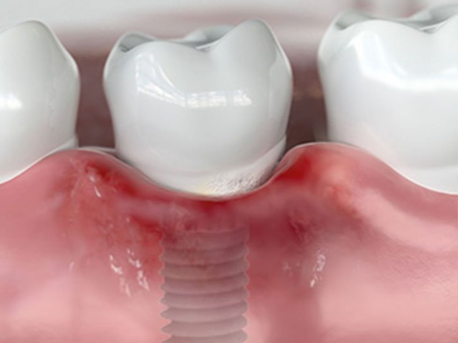 Kiểm tra mô quanh Implant xem có đỏ hay sưng không