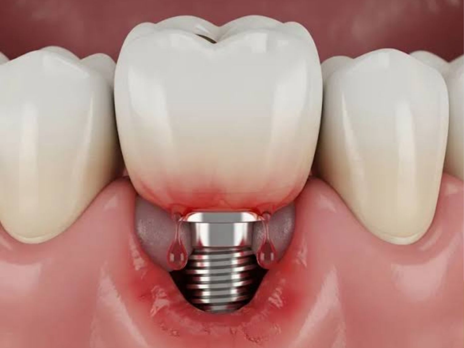 Nhiễm trùng hoặc viêm quanh Implant, ảnh mô tả
