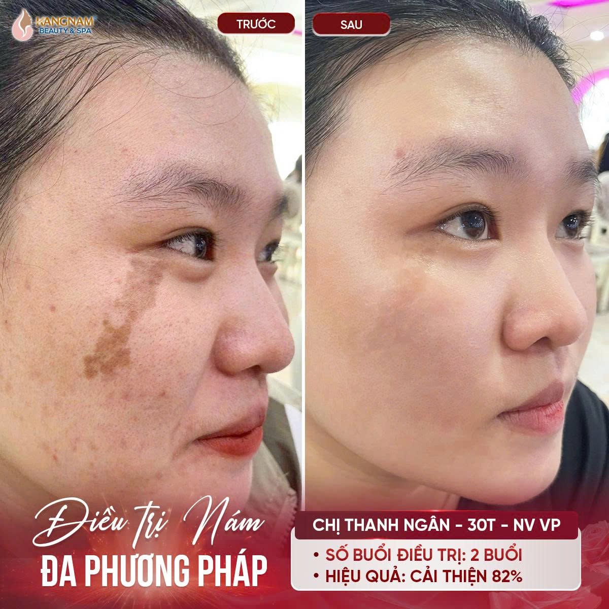 Khách hàng trước và sau điều trị nám tại Kangnam cho thấy vùng nám đậm màu trên gò má được cải thiện, nền da trông sáng và đều màu hơn.