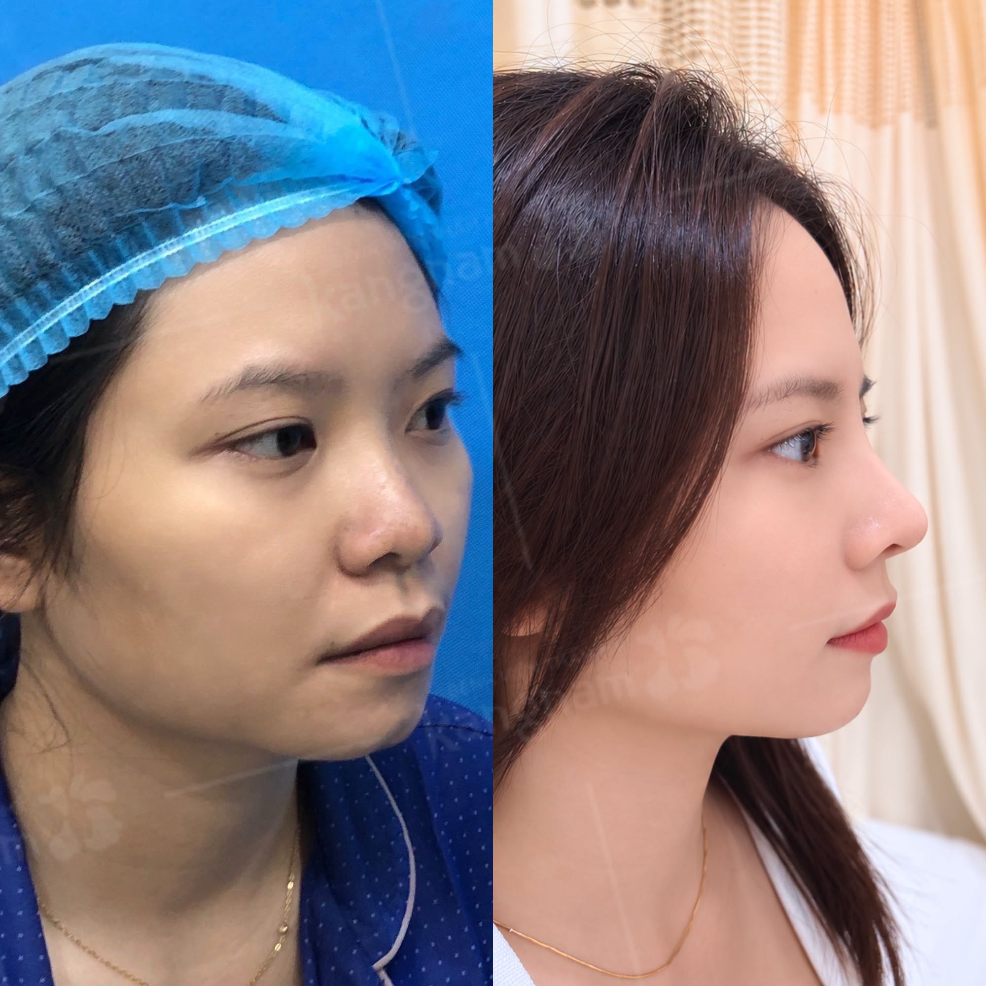 ảnh trước và sau khi khách hàng nâng mũi. Dáng mũi tự nhiên và hài hòa như thật