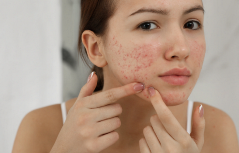 Da đang viêm hoặc kích ứng dễ xuất hiện tình trạng đỏ, nổi mụn và để lại thâm sau viêm. Việc tự nặn hoặc cạy tổn thương có thể khiến da lâu phục hồi hơn.